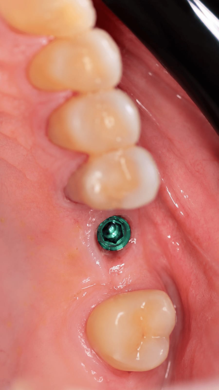 Caso Clínico 3 - Valo Dental Studio