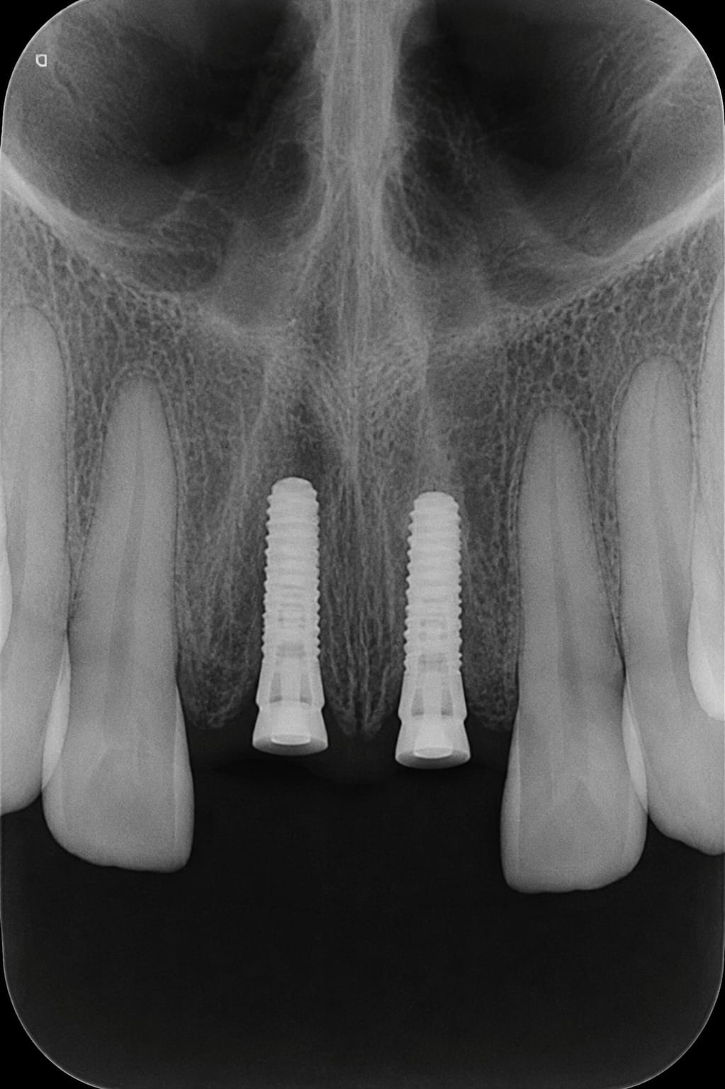 Beneficios de Implantes Dentales - Valo Dental Studio
