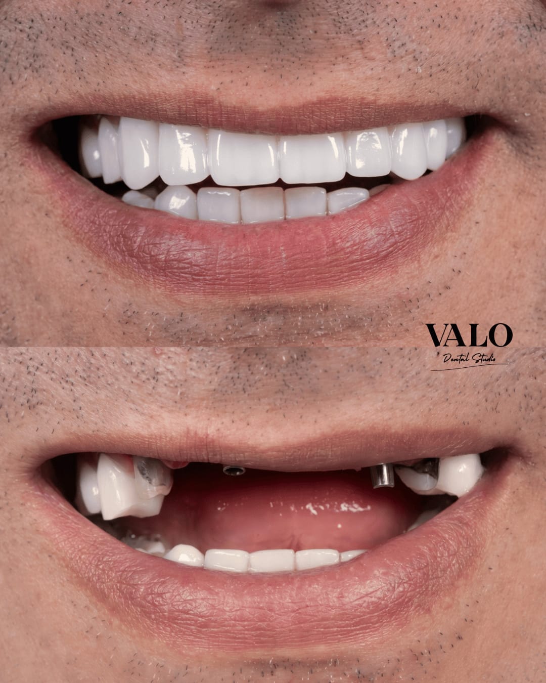 Caso Clínico 2 - Valo Dental Studio