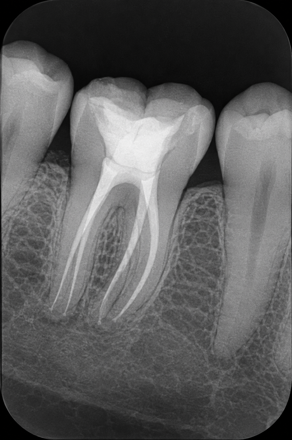 Beneficios Endodoncia - Valo Dental Studio