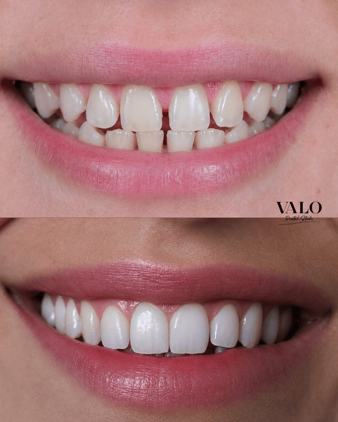 Caso Invisalign 1