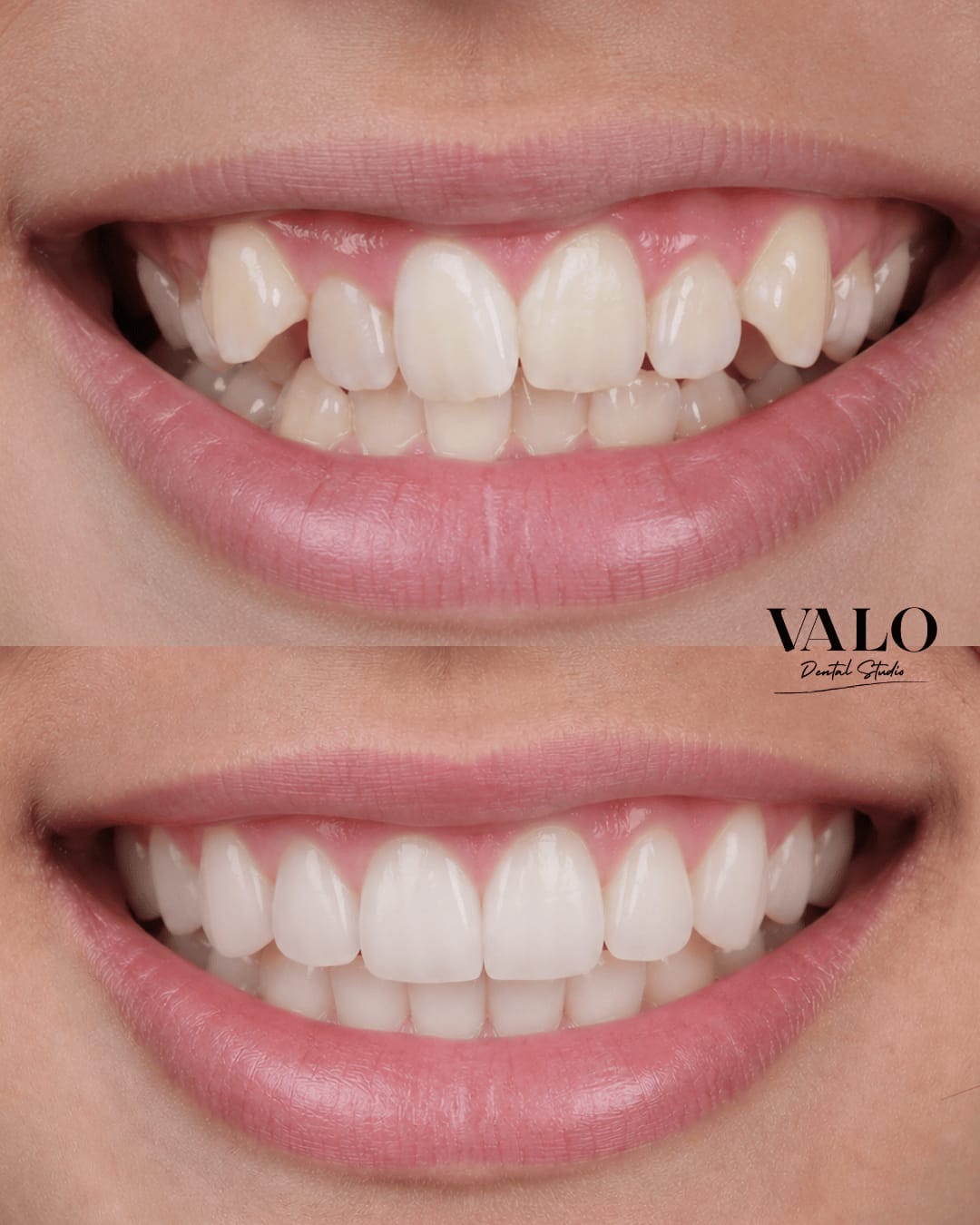 Caso Invisalign 2