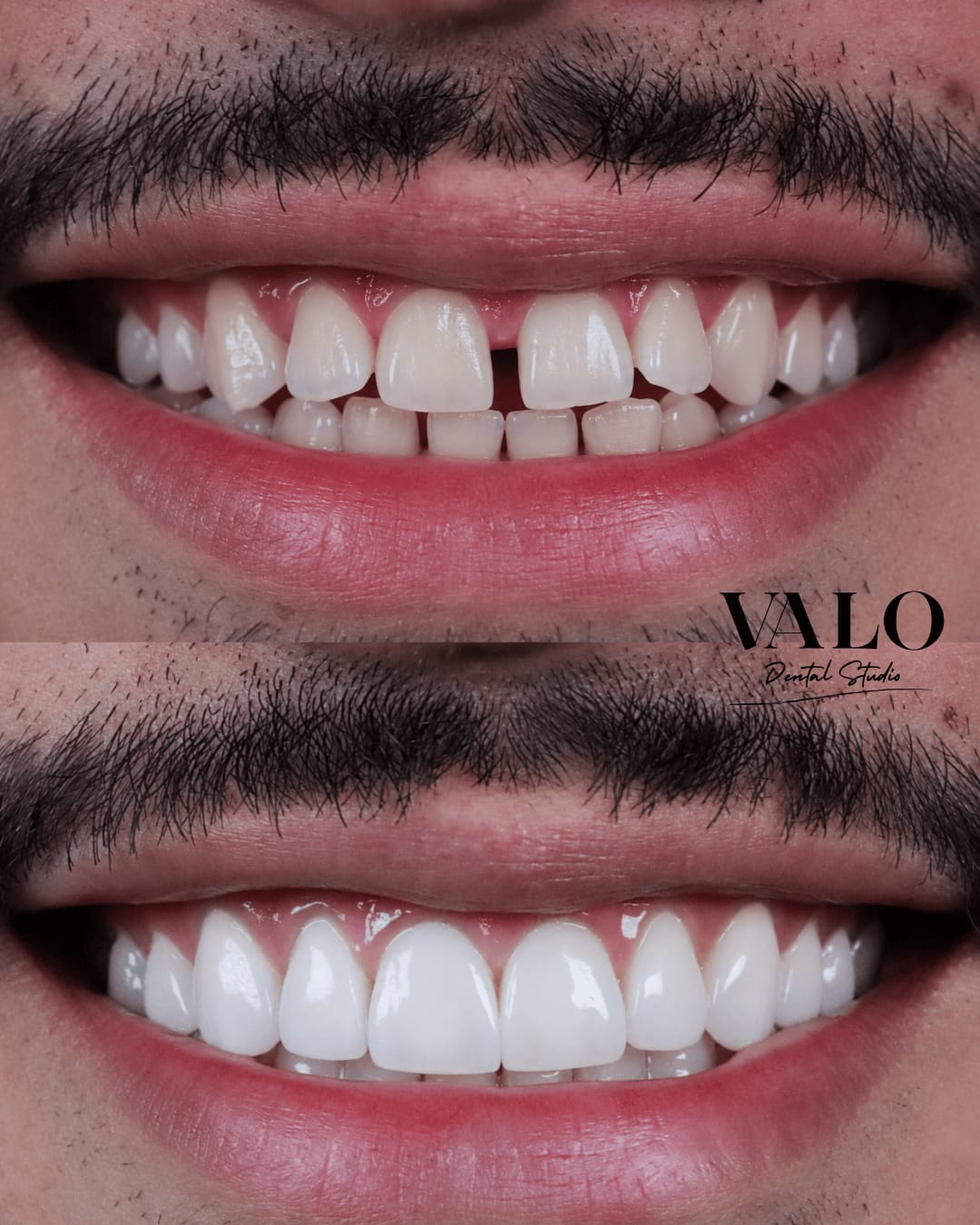 Caso Invisalign 3